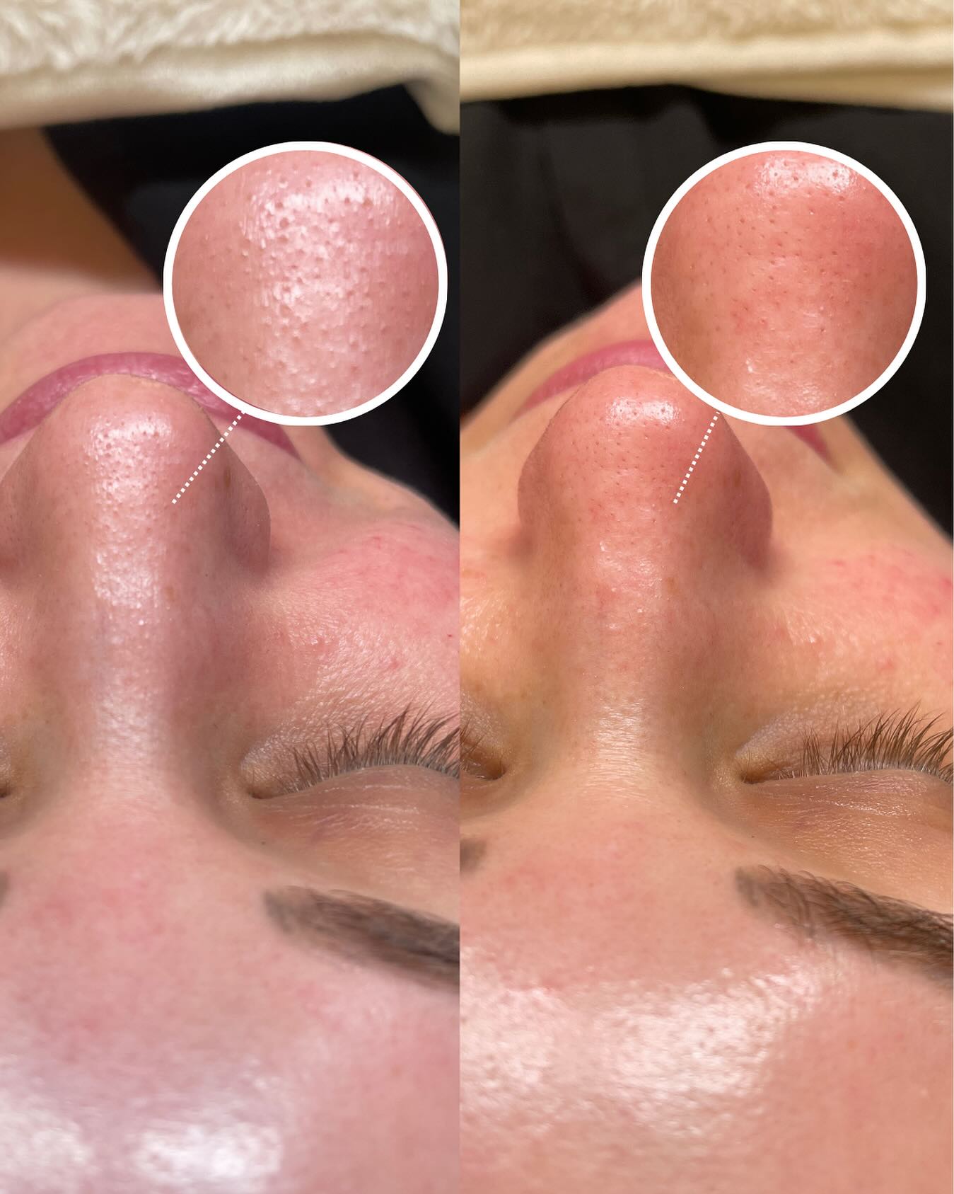 pore shrinking facial before and after