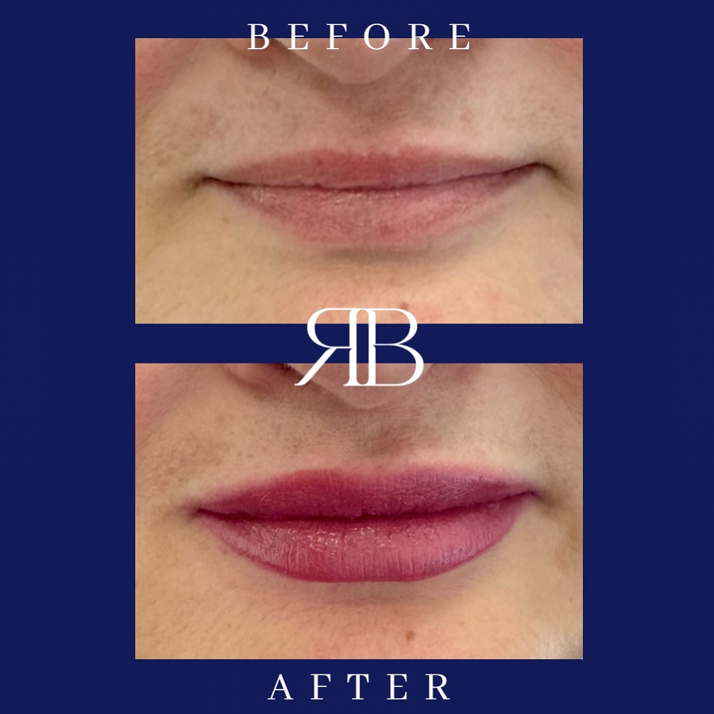 lip filler before and after